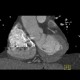 Thrombosis of the left atrial appendage: CT - Computed tomography